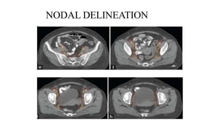 NODAL DELINEATION
 