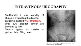 INTRAVENOUS UROGRAPHY
Traditionally it was modality of
choice in evaluating the disease
Largely replaced by CT Urography
Only 60% bladder cancer are
detected by IVP.
Tumors appear as sessile or
pedunculated filling defect
 