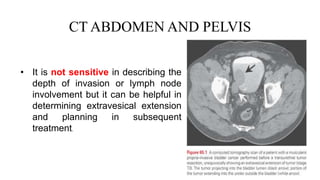 CT ABDOMEN AND PELVIS
• It is not sensitive in describing the
depth of invasion or lymph node
involvement but it can be helpful in
determining extravesical extension
and planning in subsequent
treatment.
 