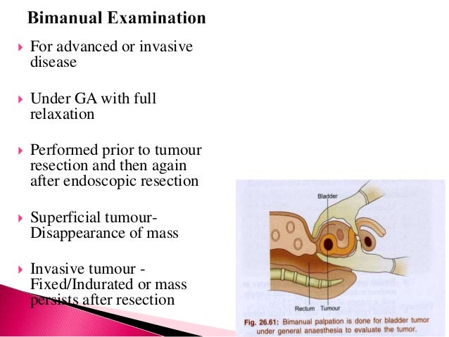 Ca urinary bladder management