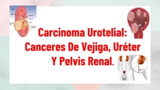 Carcinoma Urotelial:
Canceres De Vejiga, Uréter
Y Pelvis Renal.
 