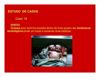 ESTUDO DE CASOS 
Caso 19 
EFEITO 
Criança,sexo feminino,nascida dentro do triste quadro dos fenômenos 
teratológicos,tendo um corpo a sustentar duas cabeças. 
 