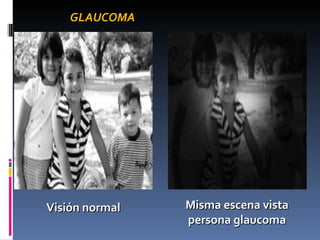 GLAUCOMA




Visión normal   Misma escena vista
                persona glaucoma
 