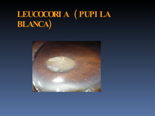 LEUCOCORI A ( PUPI LA
BLANCA)
 