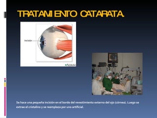 TRATAM EN
      I  TO CATARATA.




Se hace una pequeña incisión en el borde del revestimiento externo del ojo (córnea). Luego se
extrae el cristalino y se reemplaza por uno artificial.
 