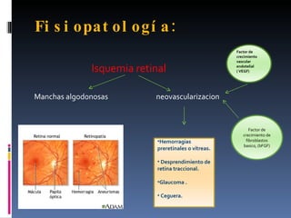 Fi s i opat ol ogí a :
                                                      Factor de
                                                      crecimiento
                                                      vascular

              Isquemia retinal                        endotelial
                                                      ( VEGF)




Manchas algodonosas        neovascularizacion


                                                             Factor de
                                                         crecimiento de
                            •Hemorragias                   fibroblastos
                                                         basico, (bFGF)
                            preretinales o vítreas.

                            • Desprendimiento de
                            retina traccional.

                            •Glaucoma .

                            • Ceguera.
 