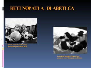 RETI NOPATI A DI ABETI CA




Visión normal. Cortesía del
National Eye Institute (EUA




                              La misma imagen vista por un
                              paciente con retinopatía diabética.
 