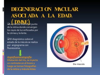 DEGENERACI ON M            ACULAR
  ASOCI ADA A LA EDAD.
  ( DM )    AE
La mácula lútea es el punto
de la retina donde convergen
los rayos de luz enfocados por
la córnea y la lente.

 El diagnóstico sobre el
estado de la mácula se realiza
por angiograma con
fluoresceína .


Angiofluoresceingrafía:
Dilatación del iris, se inyecta
un contraste en el brazo y
luego se toman fotografías
de la retina y mácula lútea.
 