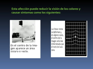 Esta afección puede reducir la visión de los colores y
causar síntomas como los siguientes:
 