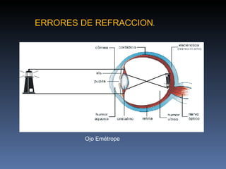 ERRORES DE REFRACCION.




         Ojo Emétrope
 