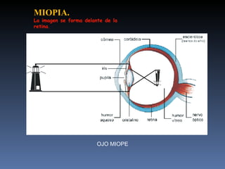 MIOPIA.
La imagen se forma delante de la
retina.




                        OJO MIOPE
 