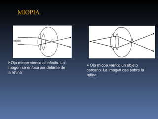 MIOPIA.




Ojo miope viendo al infinito. La
                                    Ojo miope viendo un objeto
imagen se enfoca por delante de
                                    cercano. La imagen cae sobre la
la retina
                                    retina
 