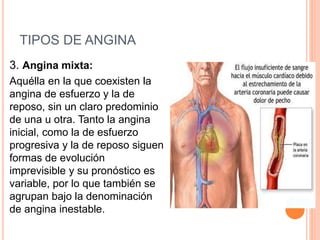 TIPOS DE ANGINA 
3. Angina mixta: 
Aquélla en la que coexisten la 
angina de esfuerzo y la de 
reposo, sin un claro predominio 
de una u otra. Tanto la angina 
inicial, como la de esfuerzo 
progresiva y la de reposo siguen 
formas de evolución 
imprevisible y su pronóstico es 
variable, por lo que también se 
agrupan bajo la denominación 
de angina inestable. 
 