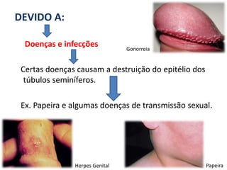 DEVIDO A:

  Doenças e infecções           Gonorreia


 Certas doenças causam a destruição do epitélio dos
  túbulos seminíferos.

 Ex. Papeira e algumas doenças de transmissão sexual.




               Herpes Genital                         Papeira
 