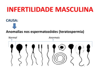 INFERTILIDADE MASCULINA
CAUSA:

Anomalias nos espermatozóides (teratospermia)
 Normal                 Anormais
 