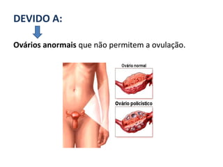 DEVIDO A:

Ovários anormais que não permitem a ovulação.
 
