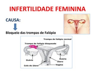 INFERTILIDADE FEMININA
CAUSA:

Bloqueio das trompas de Falópio
 