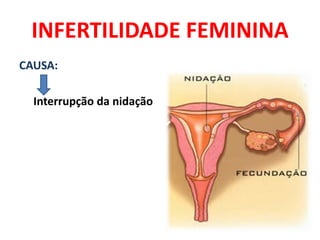 INFERTILIDADE FEMININA
CAUSA:

  Interrupção da nidação
 
