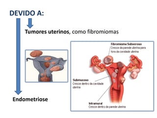 DEVIDO A:

    Tumores uterinos, como fibromiomas




Endometriose
 
