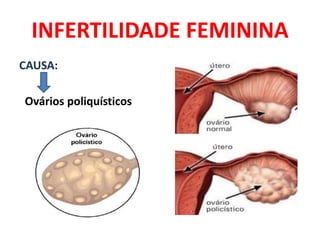 INFERTILIDADE FEMININA
CAUSA:

Ovários poliquísticos
 