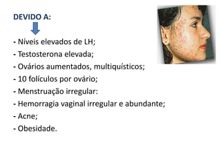 DEVIDO A:

- Níveis elevados de LH;
- Testosterona elevada;
- Ovários aumentados, multiquísticos;
- 10 folículos por ovário;
- Menstruação irregular:
- Hemorragia vaginal irregular e abundante;
- Acne;
- Obesidade.
 