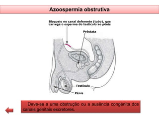 Azoospermia obstrutiva

Deve-se a uma obstrução ou a ausência congénita dos
canais genitais excretores.

 