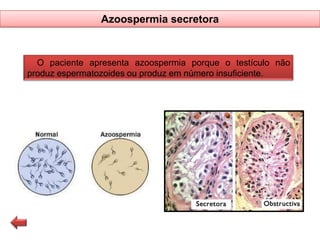 Azoospermia secretora

O paciente apresenta azoospermia porque o testículo não
produz espermatozoides ou produz em número insuficiente.

 