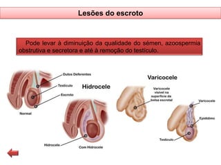 Lesões do escroto

Pode levar à diminuição da qualidade do sémen, azoospermia
obstrutiva e secretora e até à remoção do testículo.

 