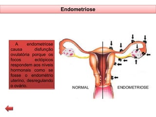 Endometriose

A
endometriose
causa
disfunção
ovulatória porque os
focos
ectópicos
respondem aos níveis
hormonais como se
fosse o endométrio
uterino, desregulando
o ovário.

 