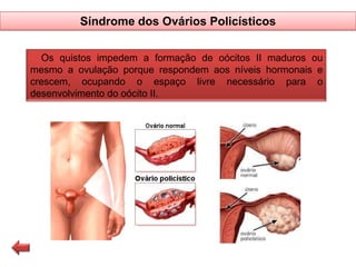 Síndrome dos Ovários Policísticos
Os quistos impedem a formação de oócitos II maduros ou
mesmo a ovulação porque respondem aos níveis hormonais e
crescem, ocupando o espaço livre necessário para o
desenvolvimento do oócito II.

 