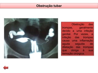Obstrução tubar

Obstrução
das
trompas,
geralmente
devido a uma infeção
genital. Por vezes, a
infeção das trompas
causa uma inflamação
aguda
seguida
de
dilatação das trompas
que
obriga
à
sua
remoção cirúrgica.

 