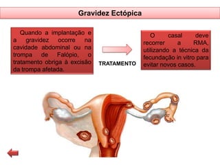 Gravidez Ectópica
Quando a implantação e
a gravidez ocorre na
cavidade abdominal ou na
trompa de Falópio, o
tratamento obriga à excisão
da trompa afetada.

TRATAMENTO

O
casal
deve
recorrer
a
RMA,
utilizando a técnica da
fecundação in vitro para
evitar novos casos.

 