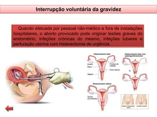 Interrupção voluntária da gravidez

Quando efetuada por pessoal não-médico e fora de instalações
hospitalares, o aborto provocado pode originar lesões graves do
endométrio, infeções crónicas do mesmo, infeções tubares e
perfuração uterina com histerectomia de urgência.

 
