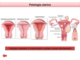 Patologia uterina

Endometrite

Infeções impedem a implantação e podem causar abortamento.

 