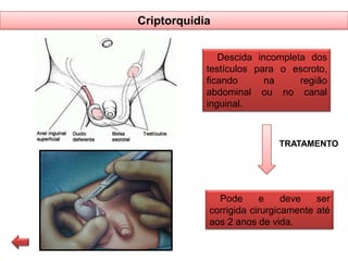 Criptorquidia
Descida incompleta dos
testículos para o escroto,
ficando
na
região
abdominal ou no canal
inguinal.

TRATAMENTO

Pode
e
deve
ser
corrigida cirurgicamente até
aos 2 anos de vida.

 