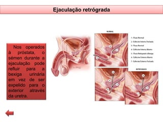 Ejaculação retrógrada

Nos operados
à próstata, o
sémen durante a
ejaculação pode
refluir para a
bexiga
urinária
em vez de ser
expelido para o
exterior através
da uretra.

 
