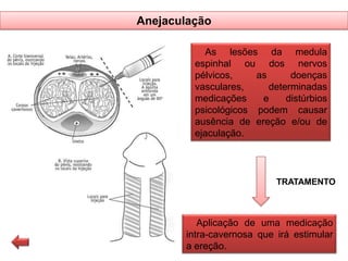 Anejaculação
As lesões da medula
espinhal ou dos nervos
pélvicos,
as
doenças
vasculares,
determinadas
medicações
e
distúrbios
psicológicos podem causar
ausência de ereção e/ou de
ejaculação.

TRATAMENTO

Aplicação de uma medicação
intra-cavernosa que irá estimular
a ereção.

 