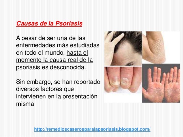La psoriasis del lugar íntimo