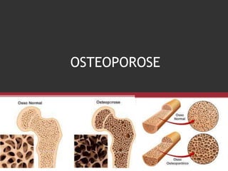 OSTEOPOROSE
 