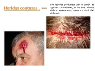 Son lesiones producidas por la acción de
agentes contundentes, en las que, además
de la acción contusiva, se vence la elasticidad
de la piel.
 