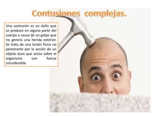 Una contusión es un daño que
se produce en alguna parte del
cuerpo a causa de un golpe que
no genera una herida exterior.
Se trata de una lesión física no
penetrante por la acción de un
objeto duro que actúa sobre el
organismo con fuerza
considerable.
 