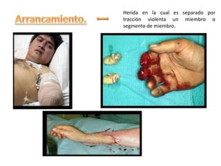 Herida en la cual es separado por
tracción violenta un miembro o
segmento de miembro.
 