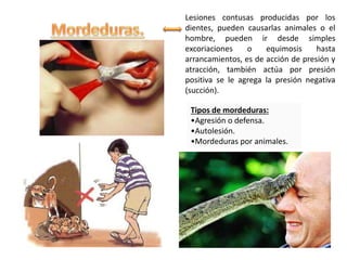 Lesiones contusas producidas por los
dientes, pueden causarlas animales o el
hombre, pueden ir desde simples
excoriaciones o equimosis hasta
arrancamientos, es de acción de presión y
atracción, también actúa por presión
positiva se le agrega la presión negativa
(succión).
Tipos de mordeduras:
•Agresión o defensa.
•Autolesión.
•Mordeduras por animales.
 