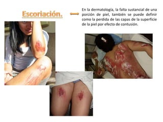 En la dermatología, la falta sustancial de una
porción de piel, también se puede definir
como la perdida de las capas de la superficie
de la piel por efecto de contusión.
 