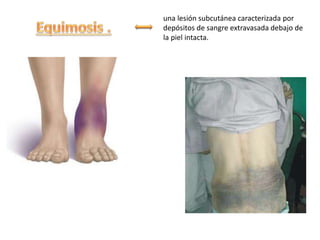 una lesión subcutánea caracterizada por
depósitos de sangre extravasada debajo de
la piel intacta.
 
