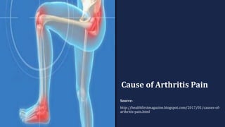 Cause of Arthritis Pain
Source-
http://healthfirstmagazine.blogspot.com/2017/01/causes-of-
arthritis-pain.html
 