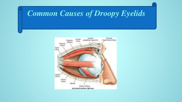 home remedy for droopy eyelids