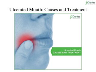 Ulcerated Mouth: Causes and Treatment
 
