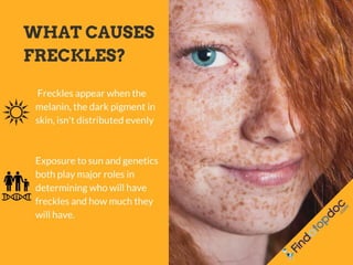 What Causes Freckles?