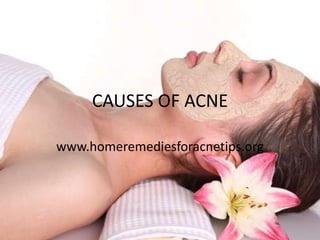 CAUSES OF ACNE

www.homeremediesforacnetips.org
 